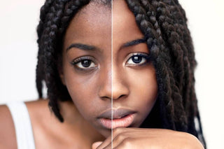 kératose pilaire comment s en débarrasser